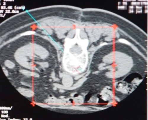 Vertèbre cible sur coupe scanner