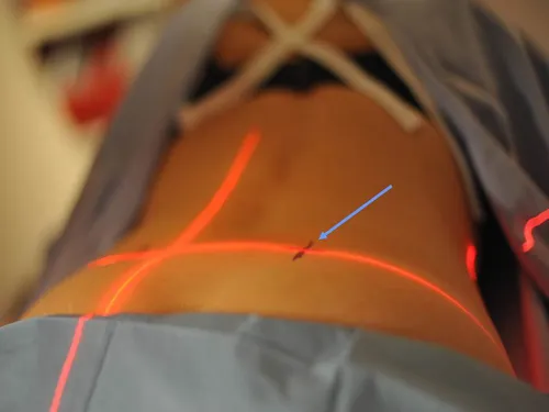 Marquage cutané au feutre et laser de repérage