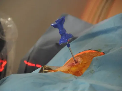 Champ stérile et trocard de cimentoplastie