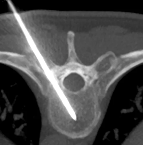 Trocard de cimentoplastie sur coupe scanner