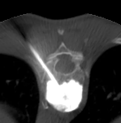 Ciment injecté dans le corps vertébral