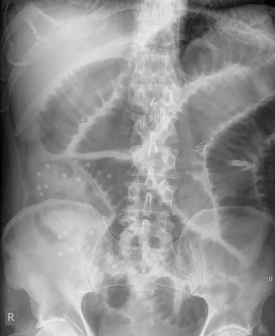 Radiographie abdominale