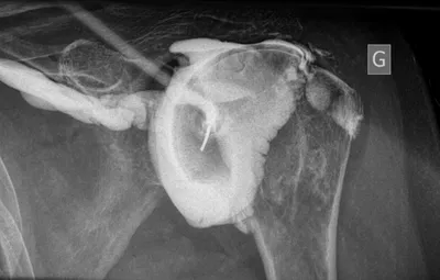 Arthrographie de l'épaule