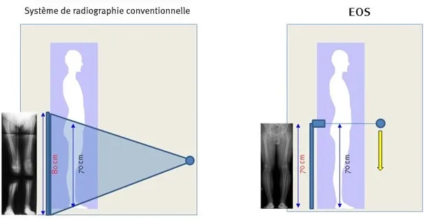 Comparaison : radiographie conventionnelle (avec agrandissement) vs EOS (sans agrandissement)