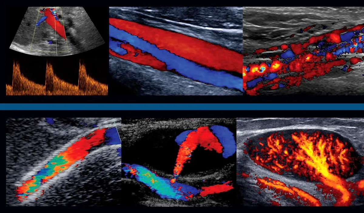 Échographie Doppler — analyse du flux sanguin vasculaire