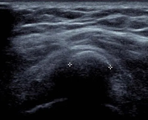 Échographie montrant une calcification tendineuse