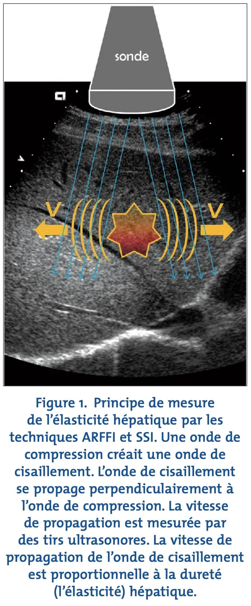 Élastographie hépatique par ondes de cisaillement