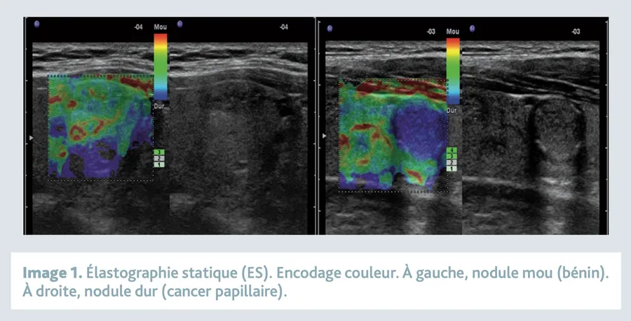 Comparaison élastographie thyroïdienne — nodule souple vs nodule rigide
