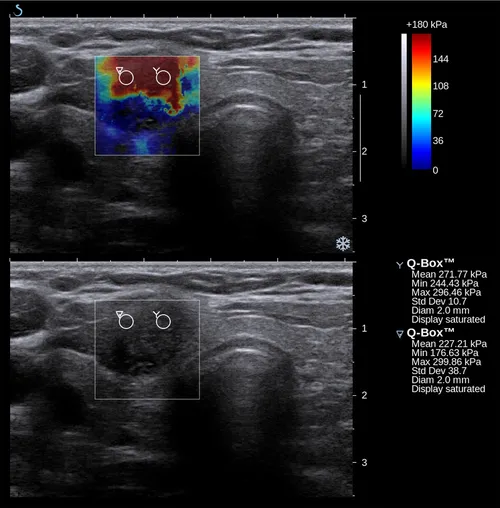 Élastographie d'un nodule thyroïdien — cartographie de rigidité