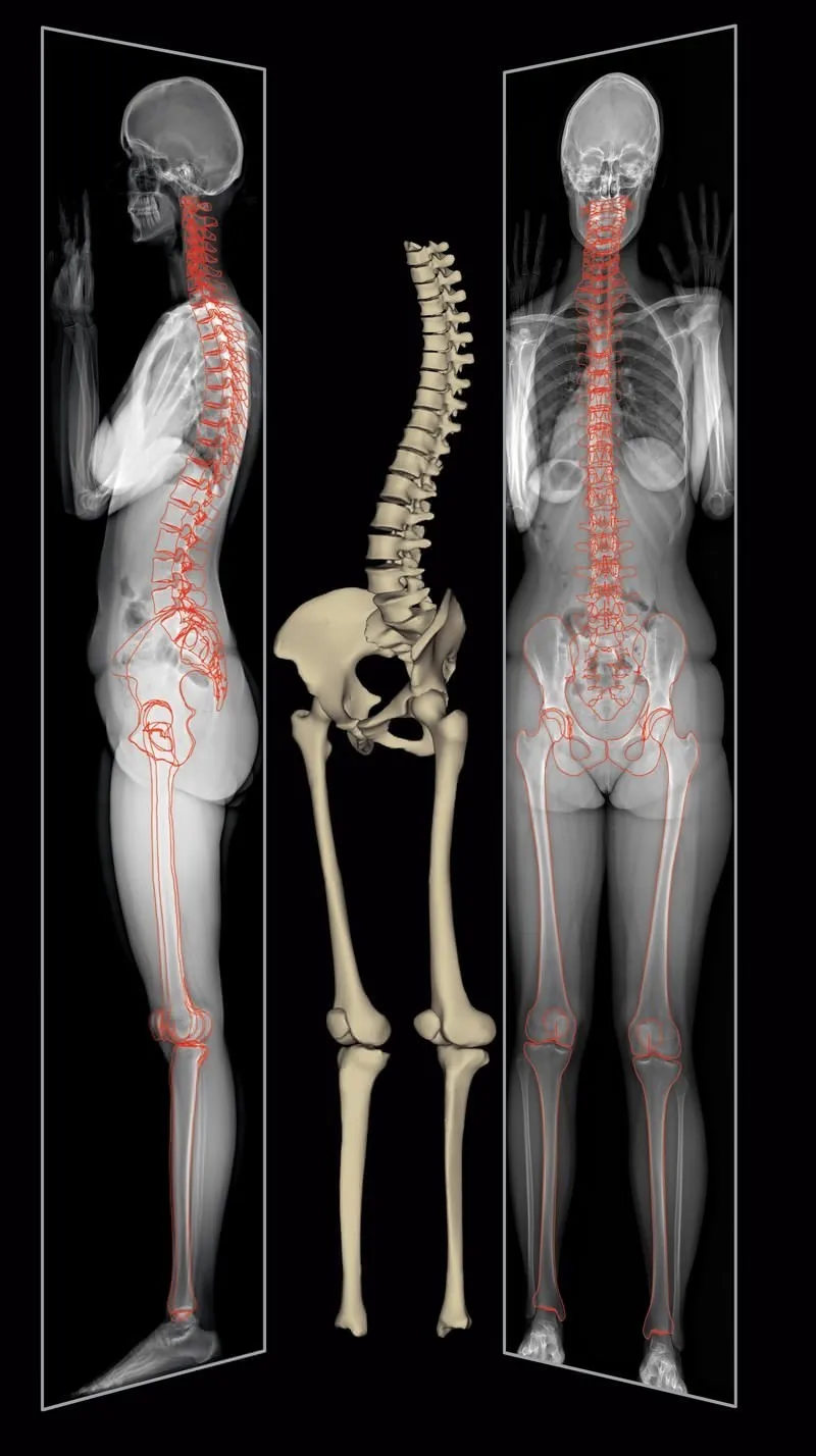 Comparaison : radiographie EOS corps entier et modélisation 3D du squelette
