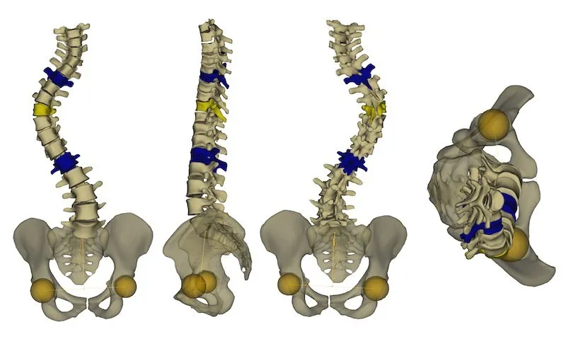 Reconstruction 3D du squelette par le logiciel SterEOS