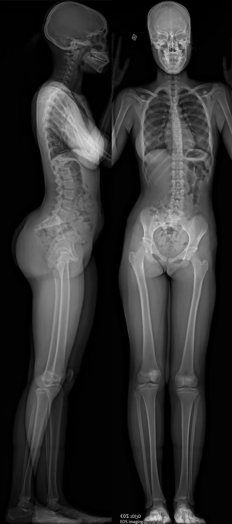 Exemple d'imagerie EOS corps entier : face et profil, de la tête aux pieds