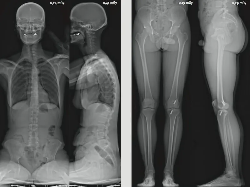 Interface EOS : analyse posturale détaillée
