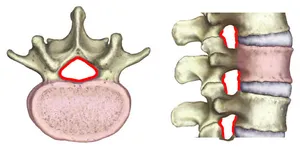 Infiltration épidurale