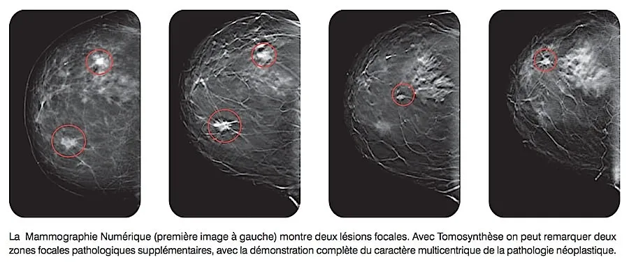 Comparaison mammographie numérique et tomosynthèse — lésions focales