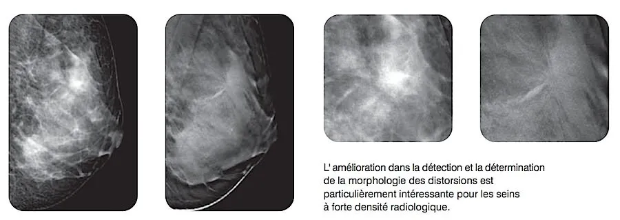 Comparaison mammographie et tomosynthèse — seins à forte densité