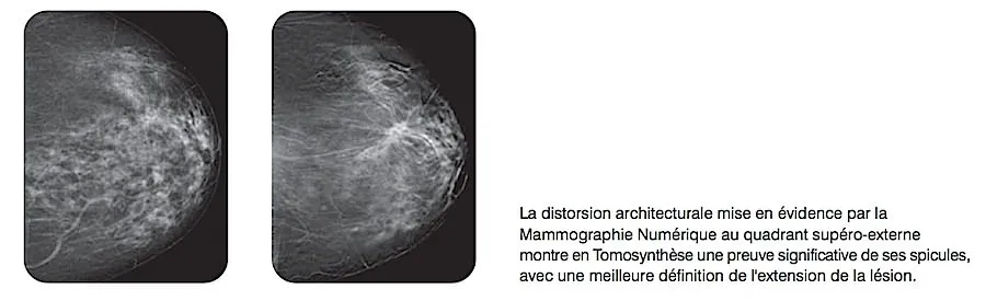 Comparaison mammographie et tomosynthèse — distorsion architecturale