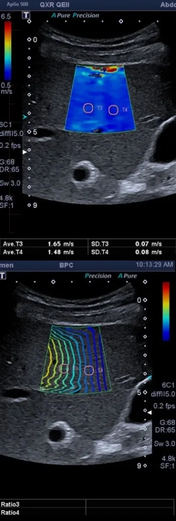Stades de la fibrose hépatique — de F0 (foie sain) à F4 (cirrhose)