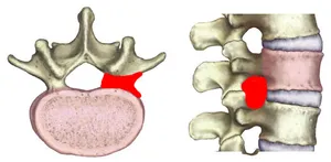 Infiltration foraminale