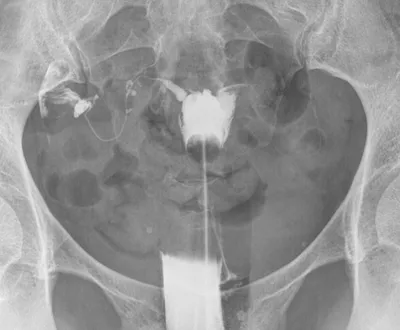 Hystérosalpingographie