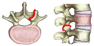 Infiltration inter-apophysaire