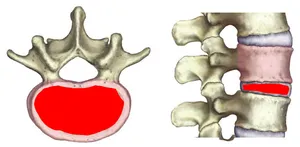 Infiltration intra-discale