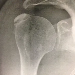 Radiographie J0 — avant traitement