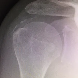 Radiographie J10 — 10 jours après