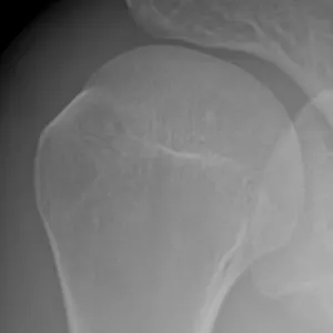 Radiographie J21 — 21 jours après