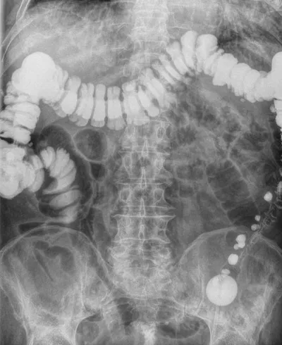 Lavement colique à la baryte
