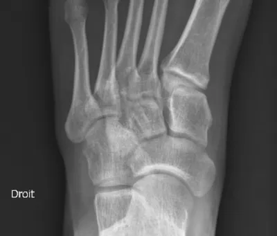 Radiographie osseuse