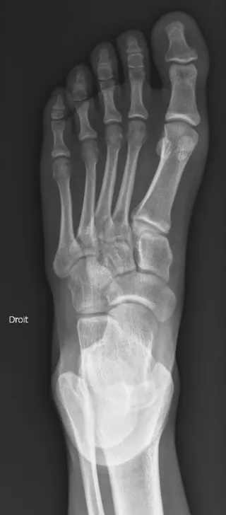 Radiographie du pied