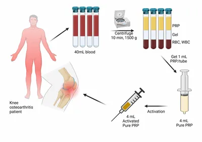 Principe de la thérapie PRP