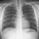 Radiographie du thorax