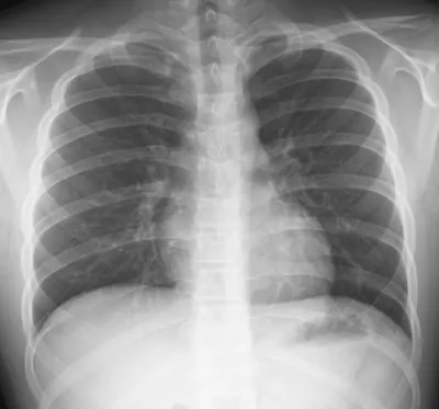 Radiographie du thorax