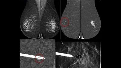 Macrobiopsie Mammaire