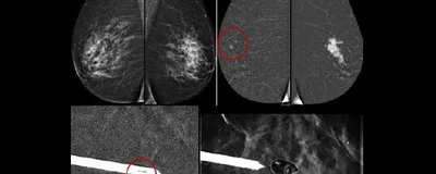 Macrobiopsie Mammaire