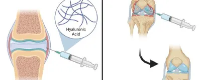 Viscosupplémentation