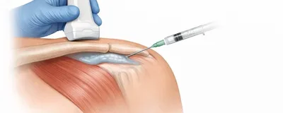 Infiltrations périphériques
