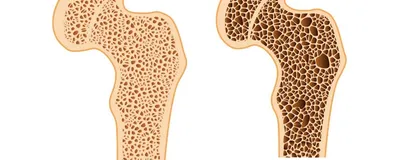 Ostéodensitométrie