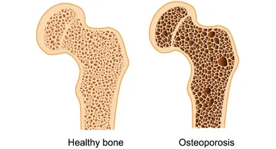 Ostéodensitométrie