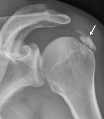 Radiographie de l'épaule montrant une calcification