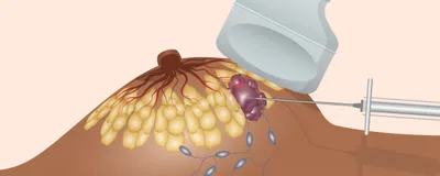 Microbiopsie Mammaire