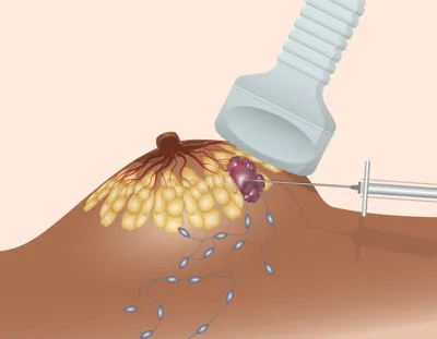 Microbiopsie Mammaire