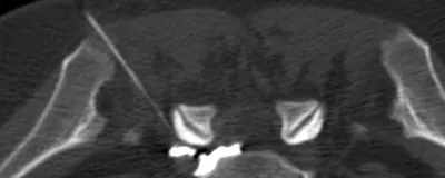 Infiltrations sous scanner