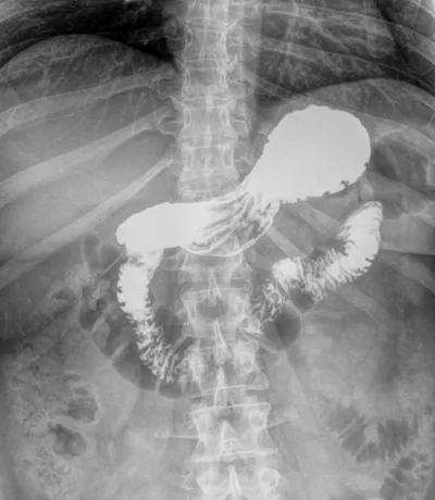 Transit oeso-gastro-duodénal