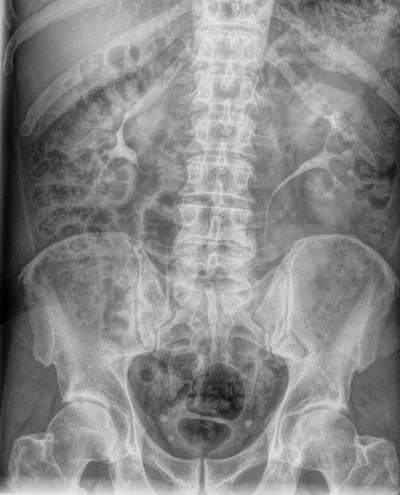 Urographie intraveineuse